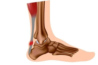 پارگی مزمن تاندون آشیل: علل، علائم و روش‌های درمان