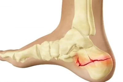 شکستگی استخوان پاشنه: علل، علائم و روش‌های درمان
