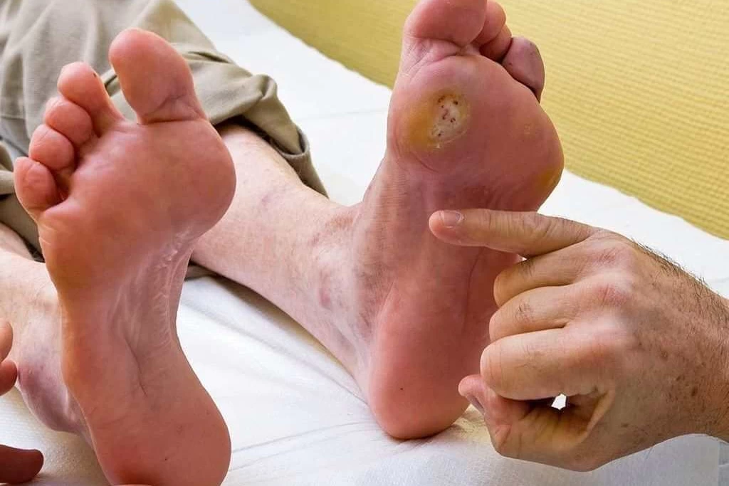 مشکلات پای دیابتی Diabetic foot