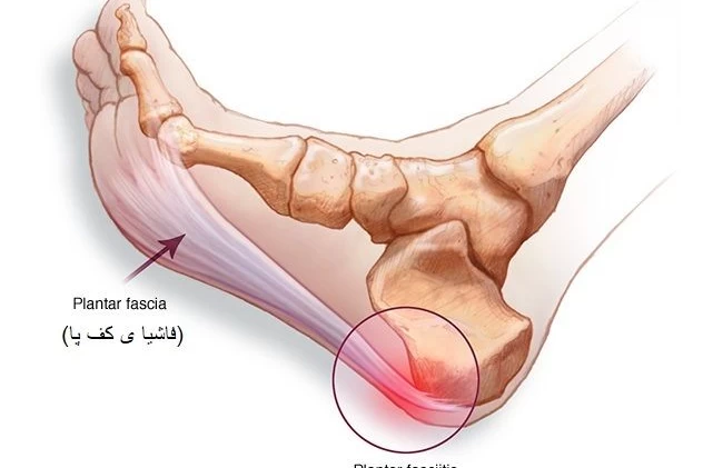 Plantar fasciitis