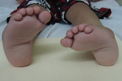 پاچنبری (Clubfoot): علل، علائم و روش‌های درمان