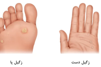 زگیل کف پا: دلایل ایجاد و روش‌های مؤثر درمان
