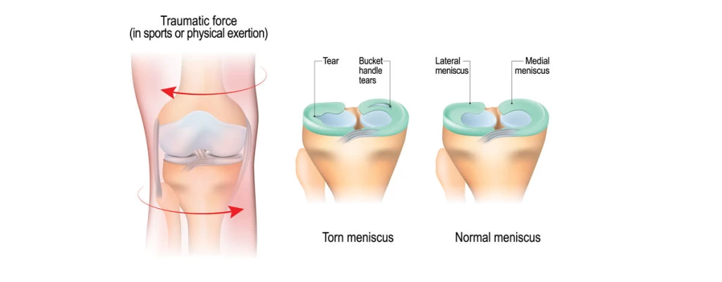 روش‌های مؤثر درمان پارگی مینیسک زانو