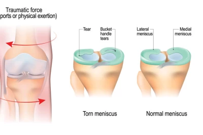روش‌های مؤثر درمان پارگی مینیسک زانو