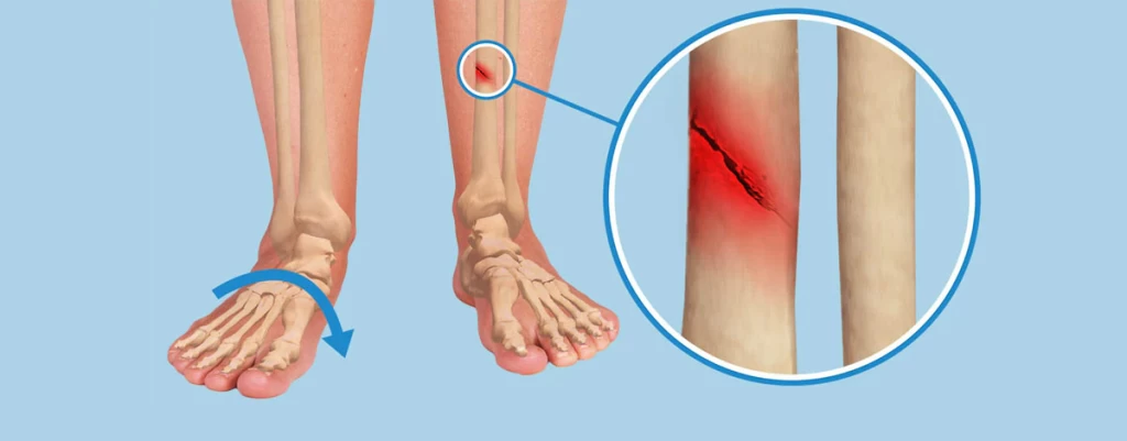 شناخت و پیشگیری از شکستگی‌های استرسی در پا و مچ پا