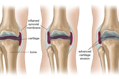 آرتریت چیست؟ (علل و روش‌های درمان)