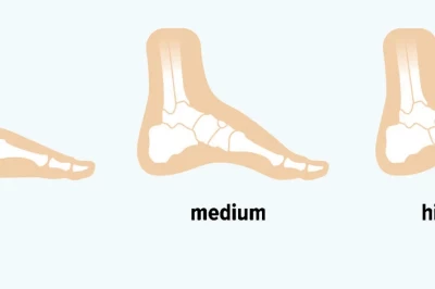 بررسی قوس و گودی کف پا: علل، علائم و روش‌های درمان