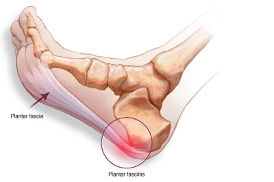 التهاب تاندون کف پا: علل، علائم، تشخیص و روش‌های درمان