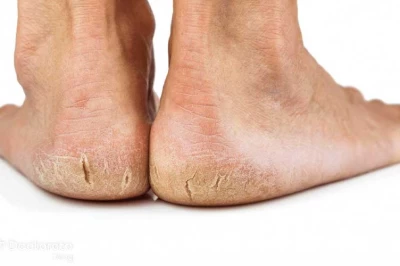 بهترین روش‌های درمان ترک پاشنه پا