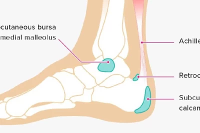 التهاب بورس پاشنه پا: علل، علائم و راه‌های درمان