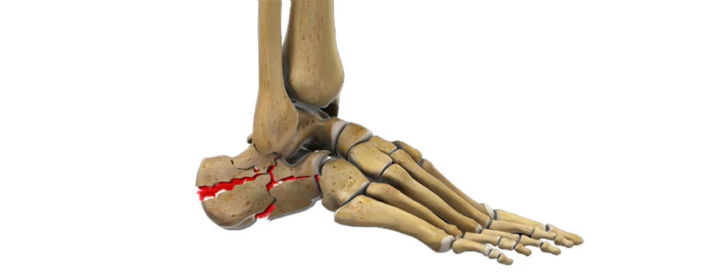 جراحی شکستگی پاشنه پا: آنچه باید بدانید