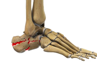 جراحی شکستگی پاشنه پا: آنچه باید بدانید