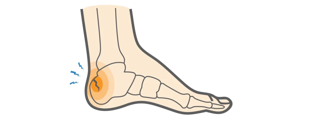شکستگی فشاری پاشنه: علل، علائم و روش‌های درمان