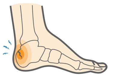 شکستگی فشاری پاشنه: علل، علائم و روش‌های درمان