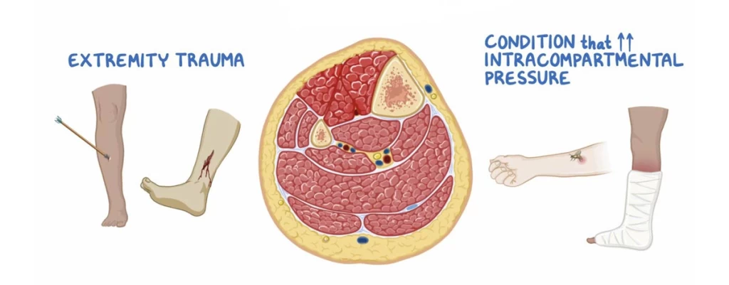همه چیز درباره سندرم کمپارتمان: انواع، علائم و روش‌های درمان