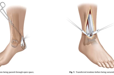 جراحی انتقال تاندون مچ پا: روش، مراقبت‌ها و نکات مهم