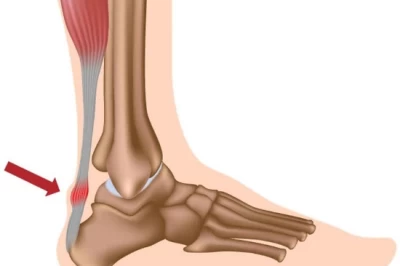درمان التهاب تاندون مچ پا: علل، علائم و روش‌های درمان موثر