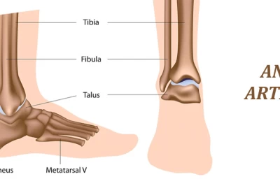 آرتروز مچ پا: علل، علائم و روش‌های درمان