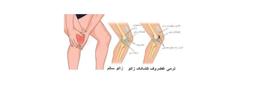 نرمی کشکک زانو: علل، علائم و روش‌های درمان
