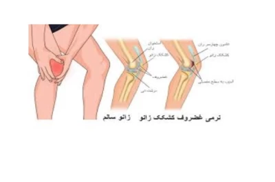 نرمی کشکک زانو: علل، علائم و روش‌های درمان