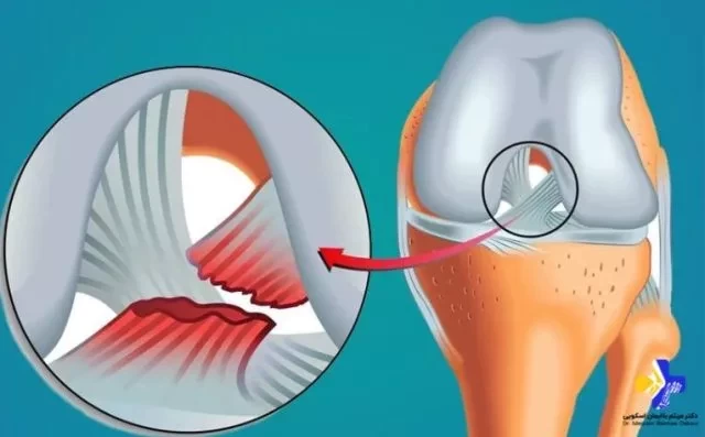 پارگی تاندون زانو: علل، علائم و روش‌های درمان