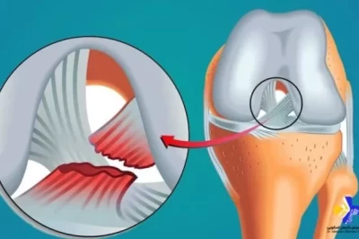 پارگی تاندون زانو: علل، علائم و روش‌های درمان