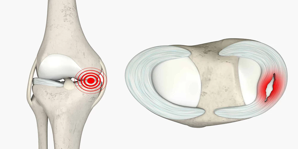 زمان بهبودی پارگی منیسک زانو بدون نیاز به جراحی چقدر است؟
