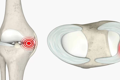 زمان بهبودی پارگی منیسک زانو بدون نیاز به جراحی چقدر است؟