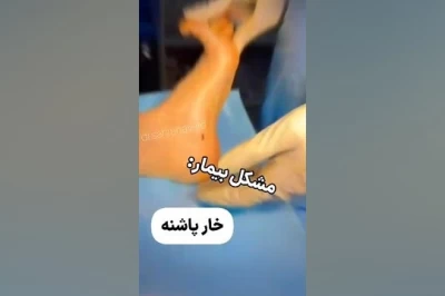 فیلم/ آرتروسکوپی مچ پا: کاربردها، مزایا و مراقبت‌های پس از عمل