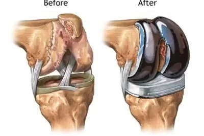 جراحی مجدد تعویض کامل مفصل زانو: دلایل، فرآیند و بهبود