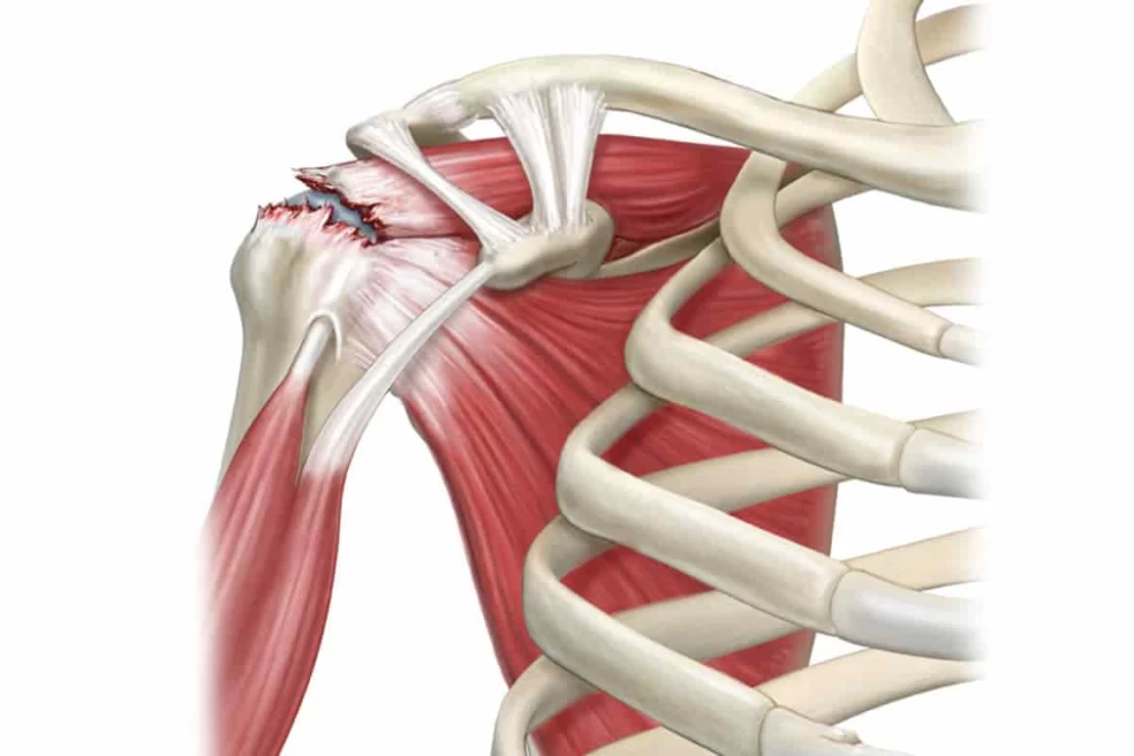 پارگی روتاتور کاف: علل، علائم و روش‌های درمانی