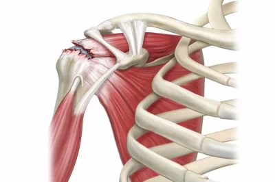 پارگی روتاتور کاف: علل، علائم و روش‌های درمانی