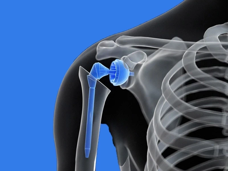 جراحی تعویض مفصل شانه: راهی برای بهبود عملکرد و کاهش درد