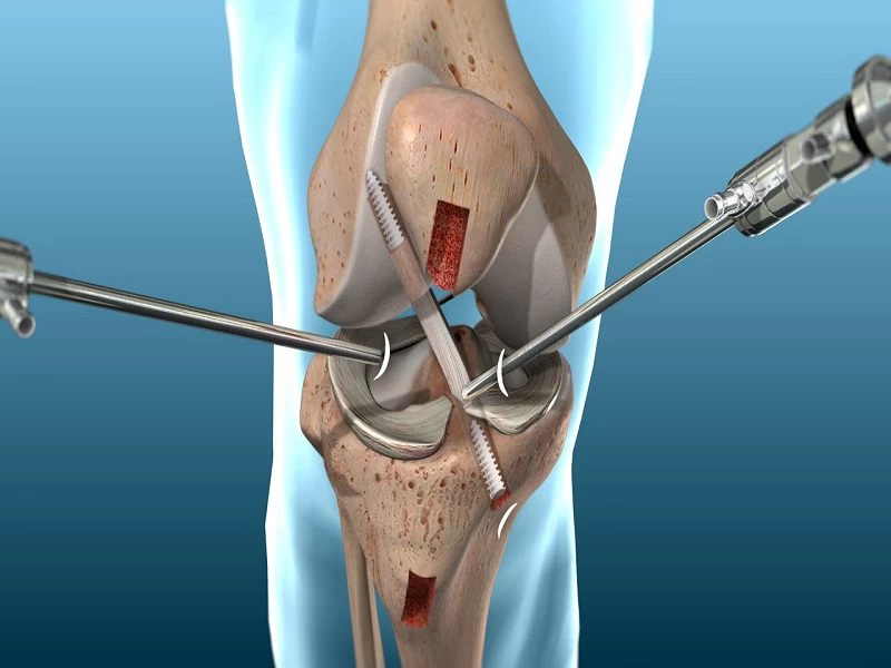 بازسازی رباط صلیبی (ACL و PCL): چه زمانی نیاز به جراحی دارید؟