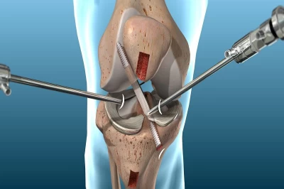 بازسازی رباط صلیبی (ACL و PCL): چه زمانی نیاز به جراحی دارید؟