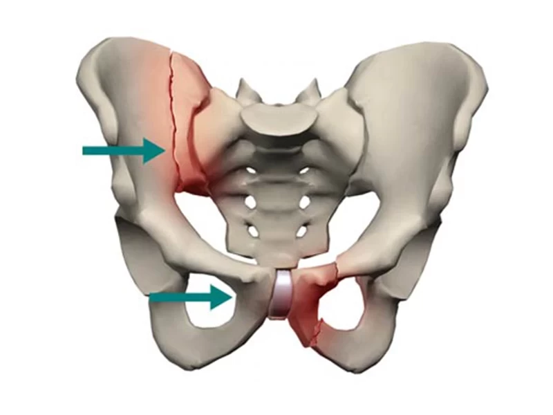 چرا شکستگی‌های لگن در سنین بالا خطرناک است؟ و چگونه باید درمان شوند؟