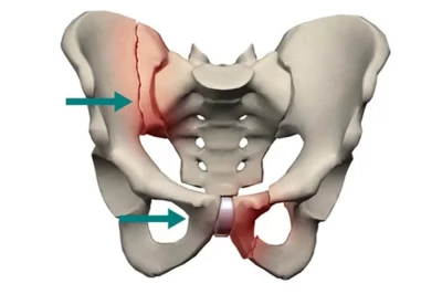 چرا شکستگی‌های لگن در سنین بالا خطرناک است؟ و چگونه باید درمان شوند؟