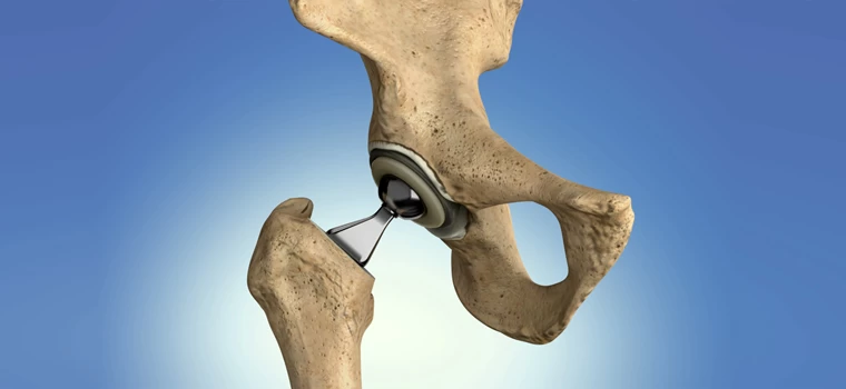 آرتروسکوپی لگن: روش نوین تشخیص و درمان مشکلات لگن