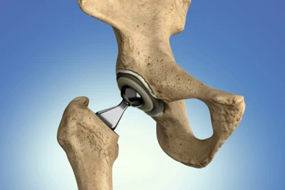 آرتروسکوپی لگن: روش نوین تشخیص و درمان مشکلات لگن