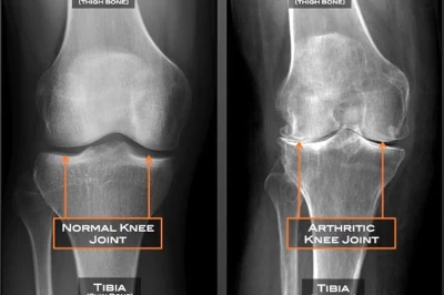 پیشگیری و درمان آرتروز زانو: راهکارهای نوین جراحی و غیرجراحی
