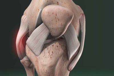 تخصص ارتوپدی در بازسازی رباط‌های زانو: از تشخیص تا درمان مؤثر