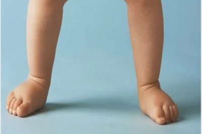جراحی اصلاح صافی کف پا در کودکان: راهکارهای درمانی برای رشد بهتر