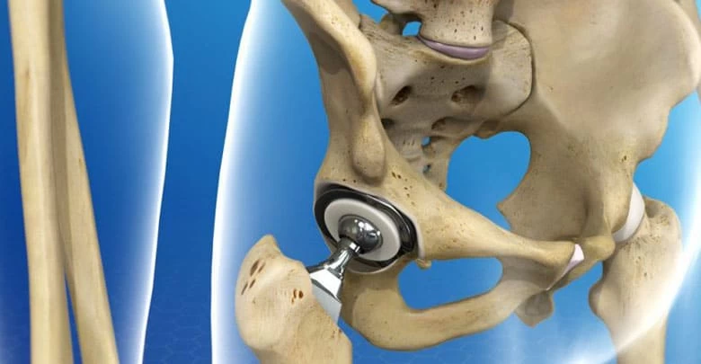 تأثیر جراحی تعویض مفصل ران بر کیفیت زندگی بیماران