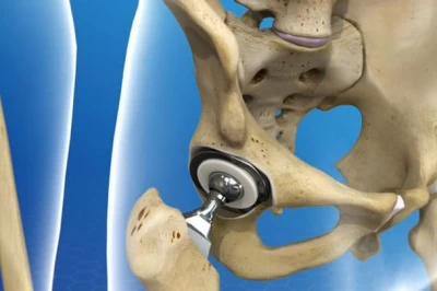 تأثیر جراحی تعویض مفصل ران بر کیفیت زندگی بیماران