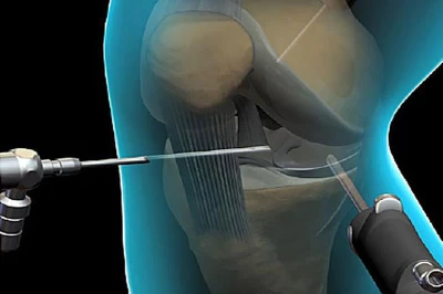 آرتروسکوپی زانو: روش‌های درمانی پیشرفته برای ترمیم منیسک و رباط‌ها