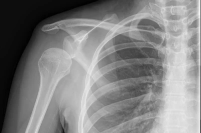 نقش جراحی‌های آرتروسکوپی در درمان پارگی لبروم و دررفتگی‌های مکرر شانه