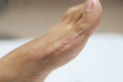 اصلاح هالوکس والگوس با جراحی: بازگشت به زیبایی و کارایی پاها