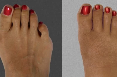 تکنیک‌های جراحی برای اصلاح دفورمیتی‌های پیچیده انگشتان پا