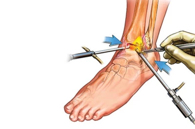 ترمیم لیگامان مچ پا: چه زمانی جراحی ضرورت دارد؟