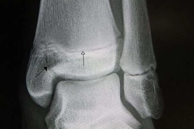 درمان شکستگی پایلون: نقش جراحی بازسازی در بازگشت به زندگی روزمره